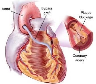 Motivation and background TREATMENT OPTIONS FOR ISCHAEMIC HEART DISEASE: Coronary Artery Bypass Grafting: surgical