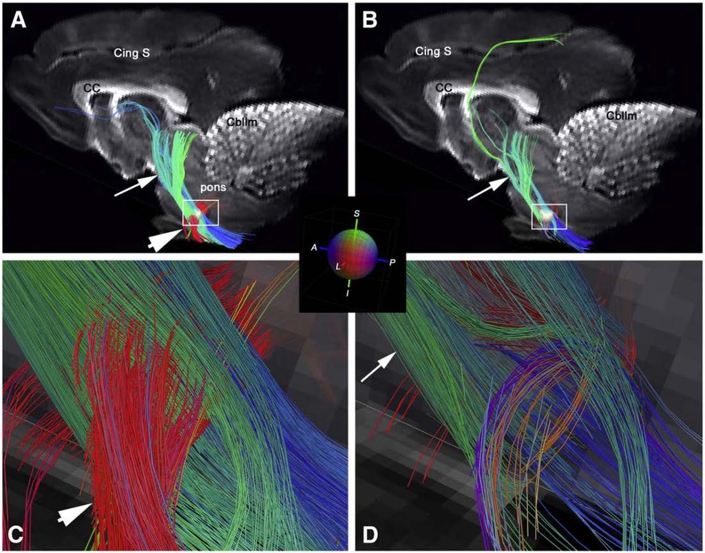 Diffusion spectrum imaging: resolving crossing fibers in the brainstem