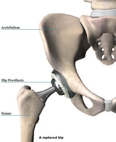 Joint Replacement The hip joint is a ball-and-socket joint, formed by the femoral
