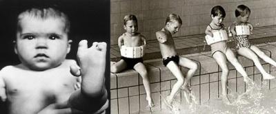 Background history 1960-62 The Thalidomide DISASTER Cases of focomelia (congenital malformation).