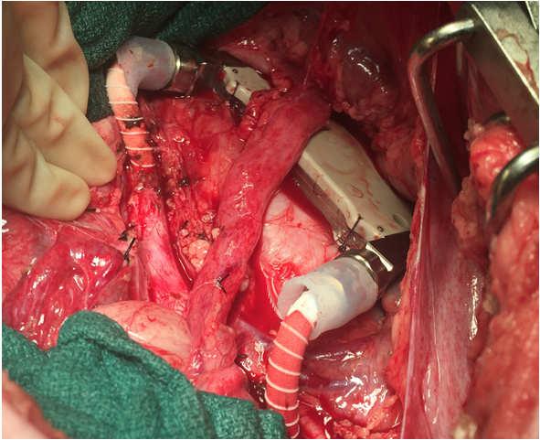 Intraoperative positioning of modified prototype Anchors Modified Vascular Interface Device Aorta External