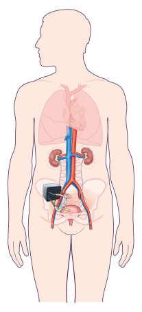 The Renal Filter Unit: the Nephron Solution - Implantable Artificial Kidney Glomerulus Proximal