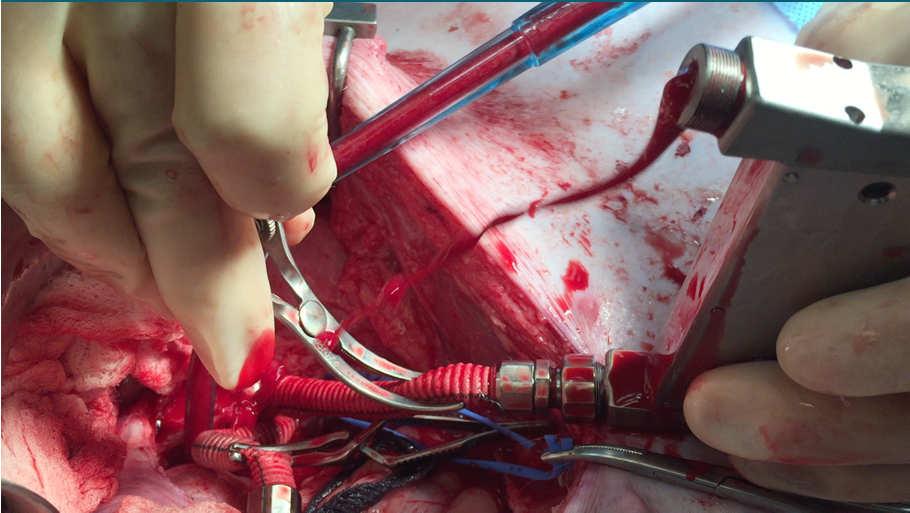 Arterial Inflow (Dacron Graft) Device Placed in Retroperitoneum Venous Outflow (Dacron Graft) 33 34 Surgical Considerations for Implantation Surgical