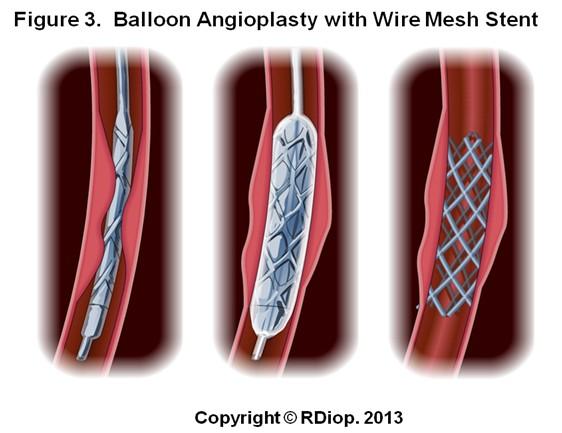 3.2. Surgical Interventions 3.2.1 Balloon Angioplasty A balloon angioplasty is a minimally invasive surgical intervention that can be performed to treat blood vessel stenosis (narrowing).