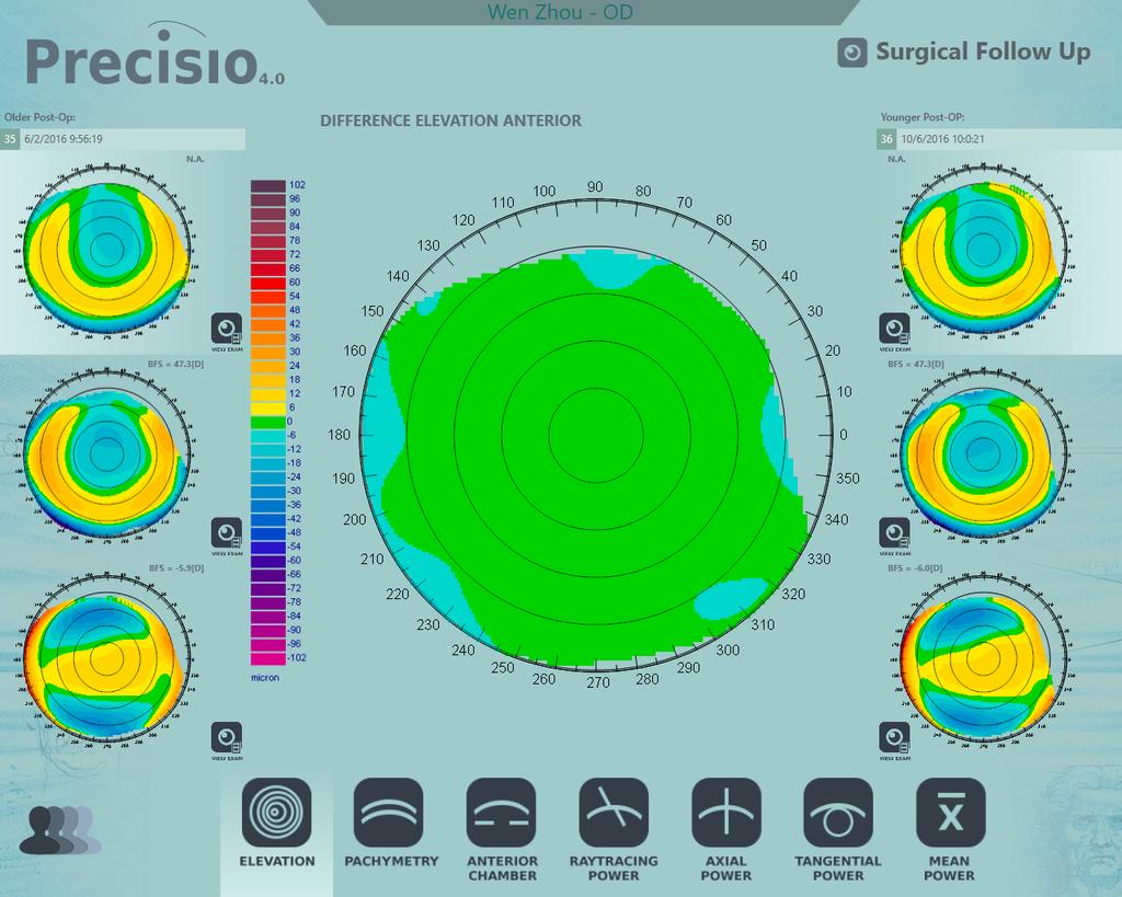 Precisio High Definition Surgical Tomography The surgical follow up provides a time related evaluation of the morphological and refractive stability