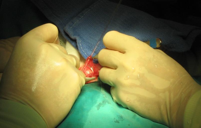 female Done surgically into oviduct