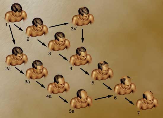 A man needs only one allele (B) for the baldness trait to be expressed, while a bald woman must be homozygous for the