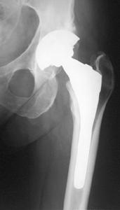 History of Total Hip Replacement Charnley (1962) 258,000 THR in US (1994) Average cost:
