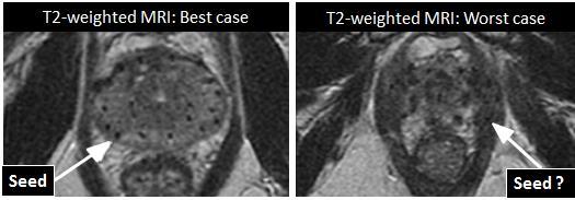 1.3.5 Current state of MRI for post-implant dosimetry An alternative imaging method for post-implant dosimetry is MRI. MRI doesn t suffer from streak artifacts like CT.
