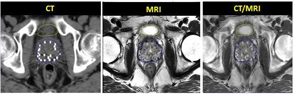 contoured prostate volume (D90) based on seed localization from the CT image was 2% variation, while the D90 varied by 7% for the use of MR-based seed localization.