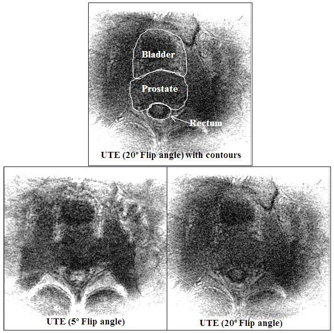 Figure 5.9: UTE scans of the prostate of a healthy volunteer.