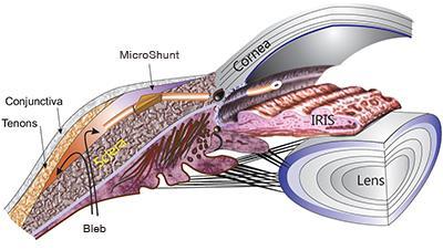 MicroShunt Designed to Offer Differentiating Features MicroShunt Micro-Invasive Surgical Design