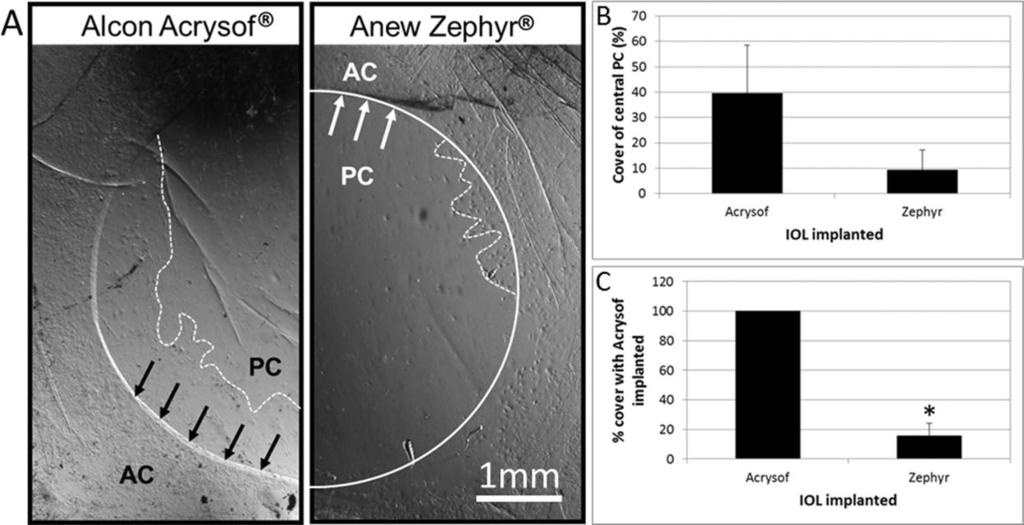 Open-Bag IOLs Reduce PCO IOVS j November 2014 j Vol. 55 j No. 11 j 7060 FIGURE 5. The Anew Zephyr IOL reduces cell coverage of the PC in serum-free conditions over a 1-month culture period.
