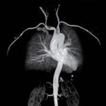 Time-resolved MR Angiography syngo TWIST 4D MRA