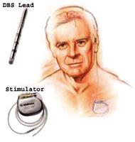 Hope for Parkinson s Disease: Electrical Stimulation Electrical