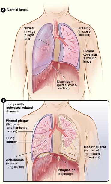 D. Potential Health Effects Related to Asbestos Routes of Entry While asbestos fibers may gain entry into the body through ingestion, the major route of exposure is inhalation.