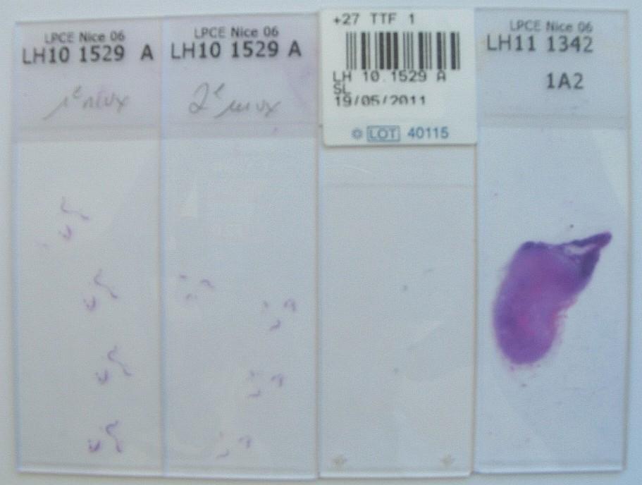 FNA 1 FNA 2 FNA3 Surgical How to collect in the future tiny tissue specimens for research projects?