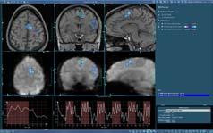 DynaSuite Neuro has improved workflow and given me greater confidence in the images and data we are collecting. This should in turn have a positive impact on patient care our ultimate goal!