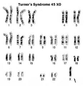 Down s Syndrome-Trisomy 21 Nondisjuntion of Sex Chromosomes Turner s