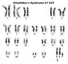Klinefelter s Syndrome 47XXY, male with an extra X chromosome,