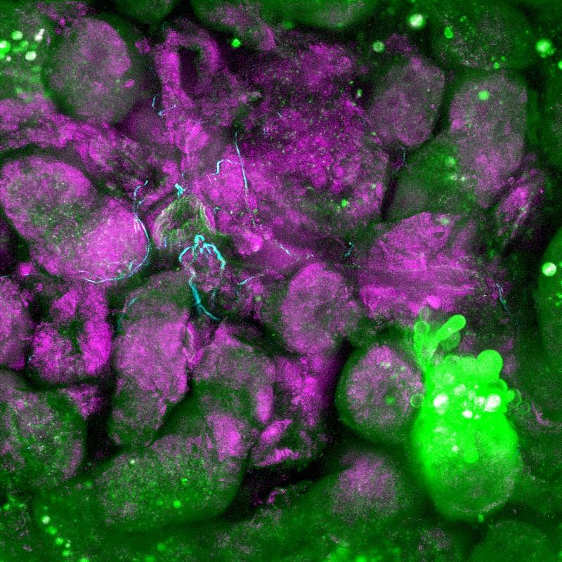 SHG / TPEF / F-CARS Early cancer metasis labeled with GFP (GREEN) invading liver tissue