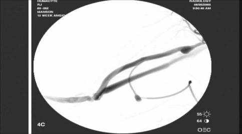 Access: Baboon with Graft Cannulation Axillary Artery