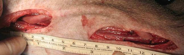 (Elbow): 2-3mm Diameter Artery Outflow Vein Arteriovenous