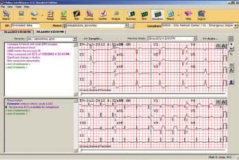 comparison Review and finalize Holter and Stress reports Set personal viewing and editing preferences ECGs can be automatically serially compared and presented in side-by-side