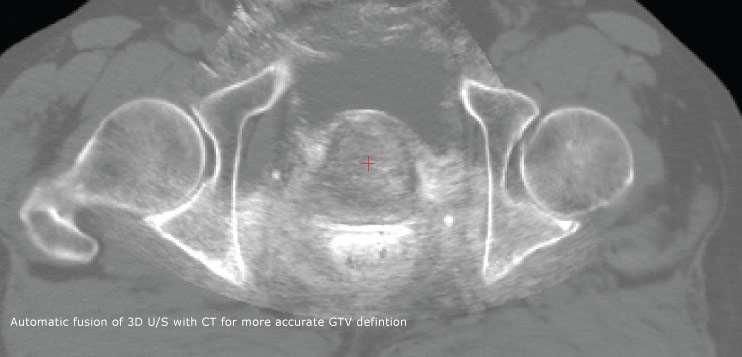 Integrated 3D ultrasound/cbct imaging for soft tissue IGRT