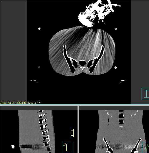 CT artifacts from Ultrasound Probe Need a model probe to avoid planning CT artifacts for