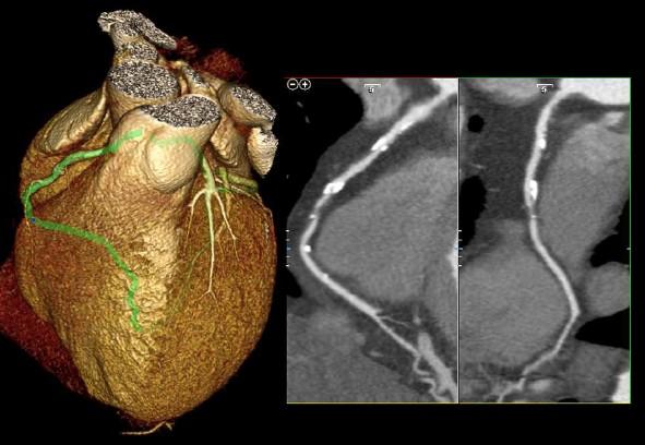 Low dose acquisitions in coronary CT angiography 100 % 50