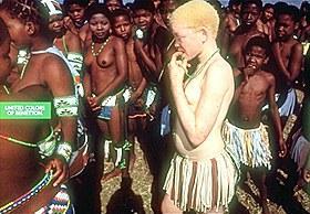Skin color: Albinism
