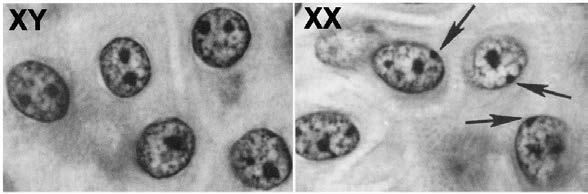 Barr Body Inactivation of the X chromosome is random and occurs independently in embryonic cells giving rise to a (having clusters of cells