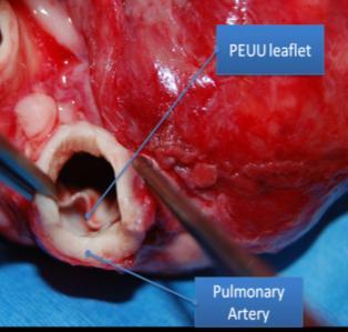 Parameters Clinical application PEUU Leaflet Pulmonary artery