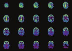 18 F-FDG PET brain imaging and quantitative analysis to evaluate