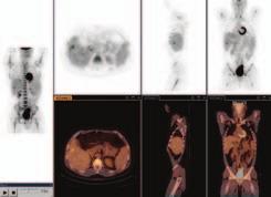 100 mas, 5-mm slice Lung cancer (84.8-kg patient). Scan protocol: TruFlight PET: 11.