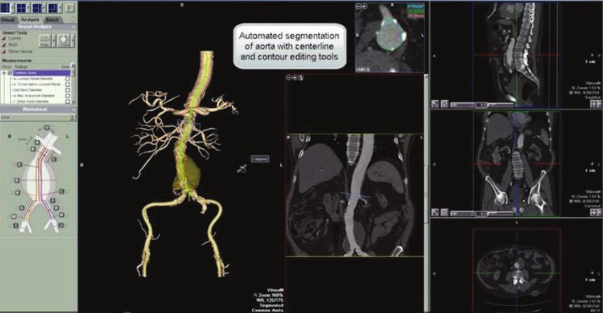 Software Applications included are: CT Liver Analysis, CT Endovascular Stent Planning (EVSP), CT Renal, CT Runoff, CT Vascular Aorta, CT Carotid, and CT Circle of Willis.