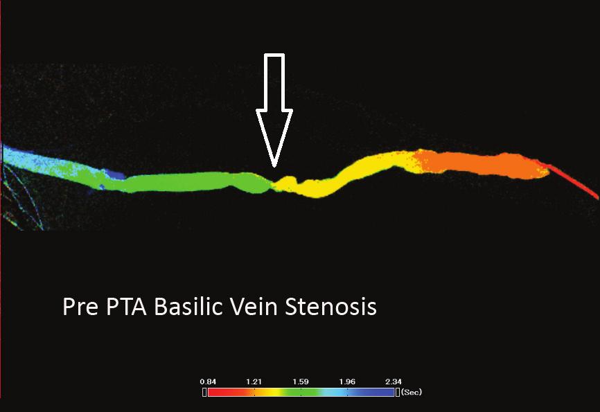 vein stenosis showing