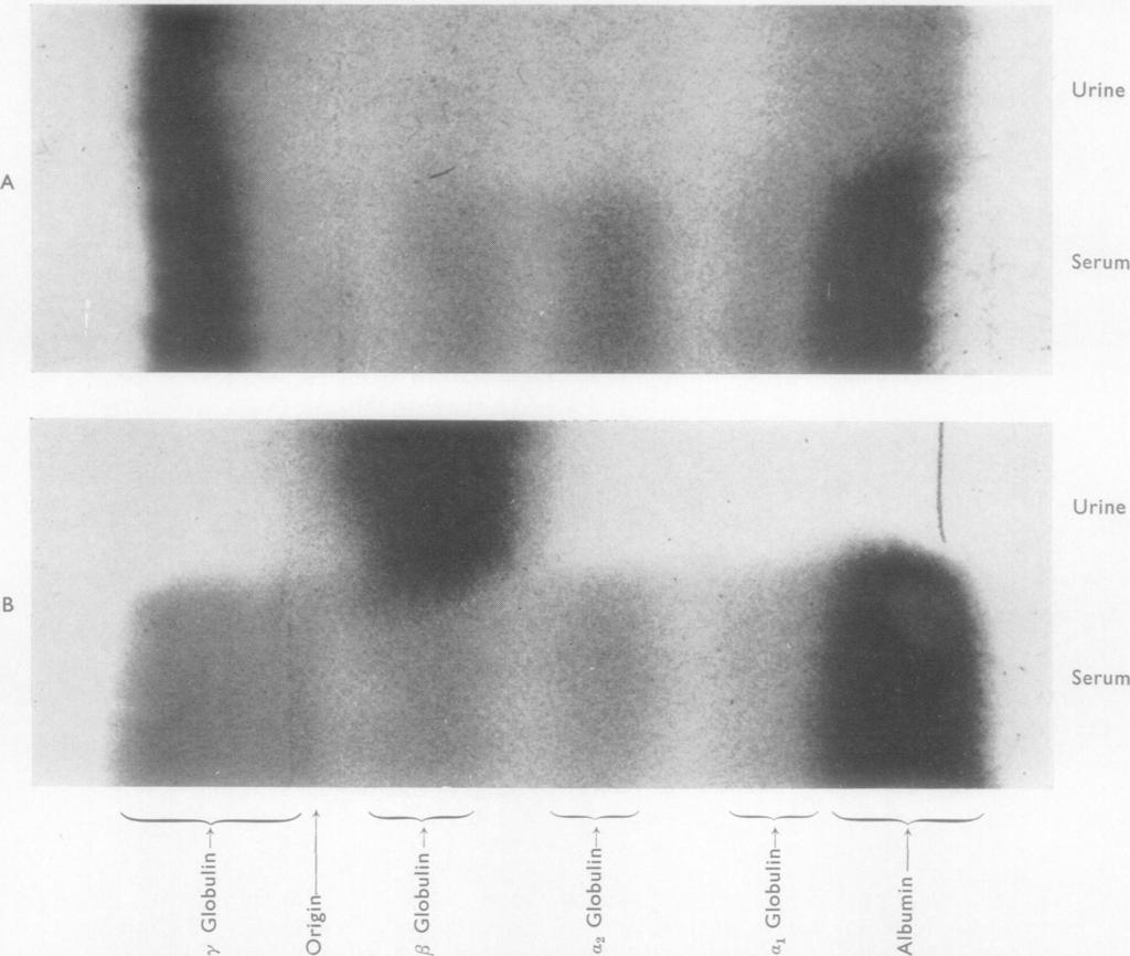 336 F. V. FLYNN and ELIZABETH A. STOW FIG. 1.-Electrophoresis of serum and urine proteins run alongside one another on paper.