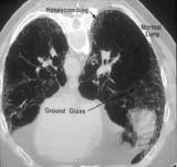 chest scan (b) HRCT chest scan (c) MRI