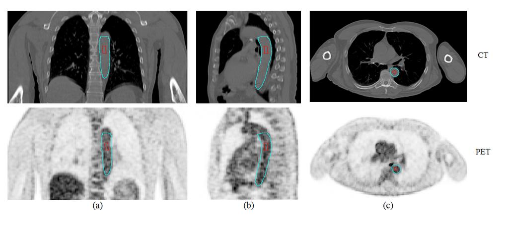 Figure 5. A PET-CT study demonstrating the segmentation of the descending aorta and its use in the placement of the VOI reference for subsequent PERCISTbased thresholding.