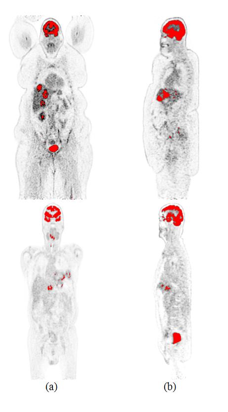 respectively from left to right. Fig. 6 illustrates an example of using the VOI reference in the calculation of SUVLBM thresholding for two PET-CT studies with liver tumour(s).