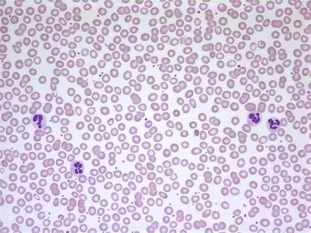 Figure 1. Granulocytes circulating in the blood of a patient with a normal peripheral smear Maslak, P.