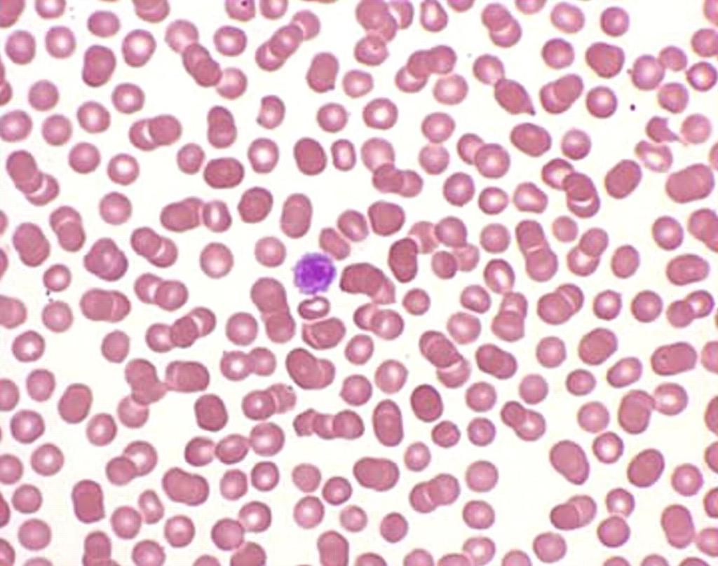 Figure 2. Peripheral smear in a patient with ITP showing an almost total absence of platelets Lazarchick, J.