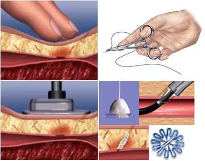 Lateral overlap: vascular closure device The applicant firstly declared that: The four vascular closure methods can be substituted for each other, so they can be defined as in a market.