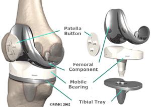 Total Hip Replacement Implant