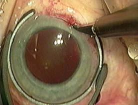 Arcuate Incisions Traditional, Handheld Diamond Knife Manually executed by tracing corneal marks Inconsistent depth