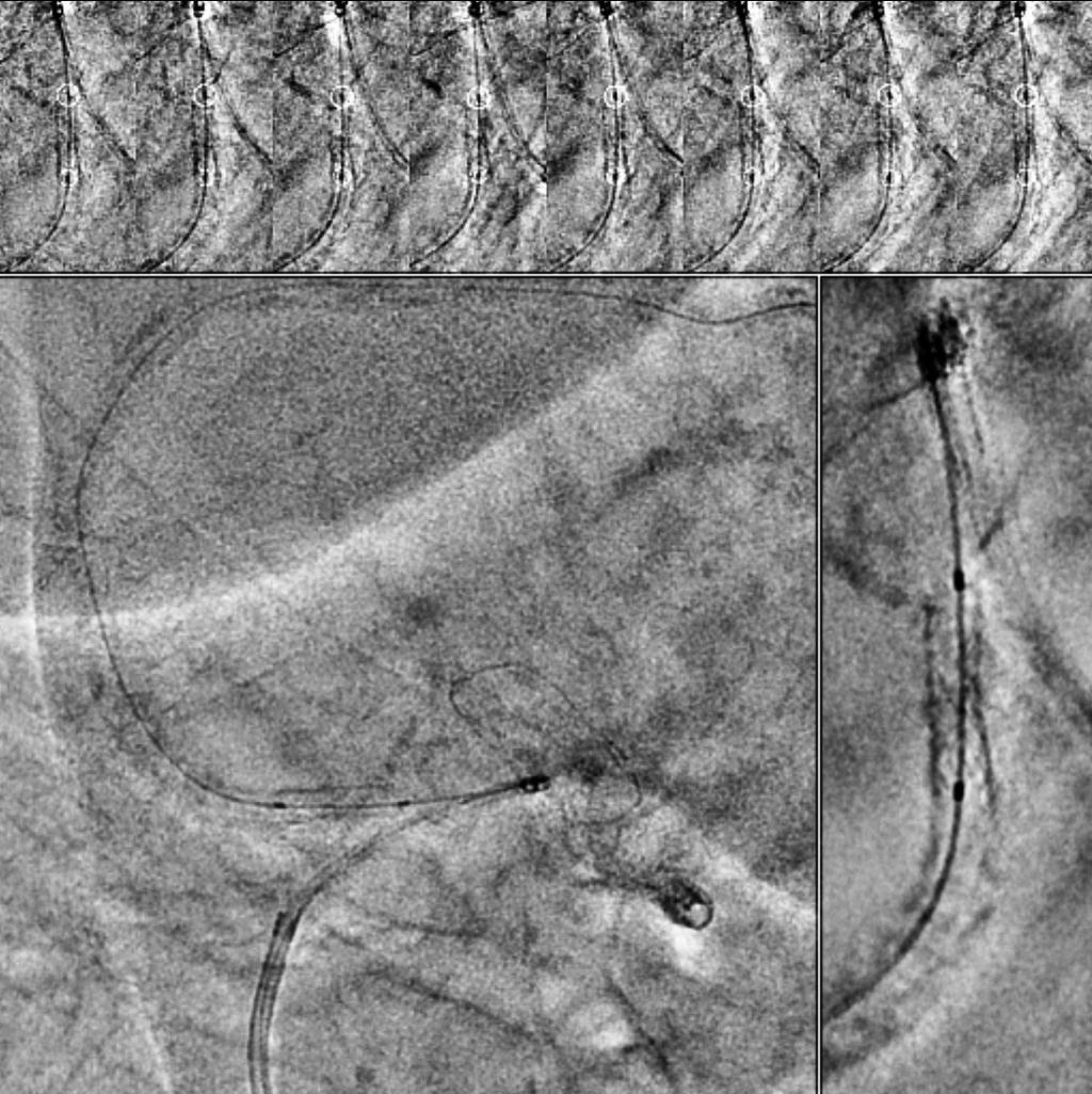 processing capability that allows both enhancing stents and showing them in a fixed position on the screen, which makes the stent appear stationary and unaffected by cardiac
