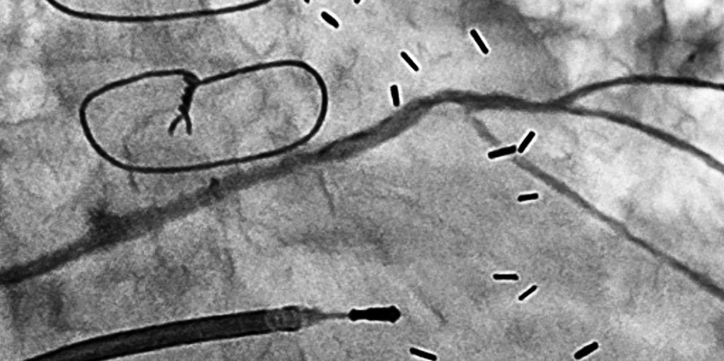 With stent images unaffected by cardiac beat, it is easy to understand the relationship between the positions of stent edges and markers, which is immensely helpful in