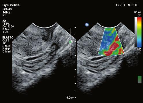 Strain elastography to enhance diagnostic confidence Elastography on Affiniti 30 for breast and gynecology ultrasound exams provides highly sensitive and specific information that can be used to